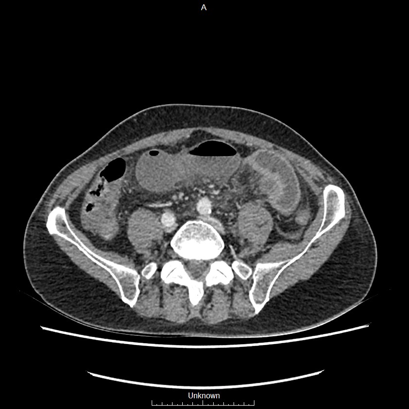 Closed loop bowel obstruction and ischemia (Radiopaedia 86959-103180 A 57).jpg