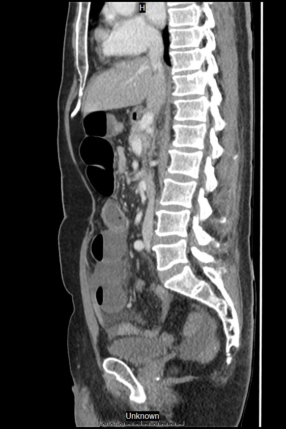 Closed loop bowel obstruction and ischemia (Radiopaedia 86959-103180 C 35).jpg