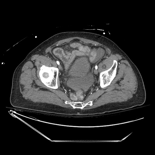 File:Closed loop obstruction due to adhesive band, resulting in small bowel ischemia and resection (Radiopaedia 83835-99023 B 134).jpg
