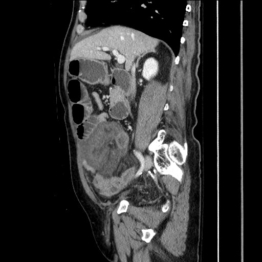 File:Closed loop obstruction due to adhesive band, resulting in small bowel ischemia and resection (Radiopaedia 83835-99023 F 77).jpg