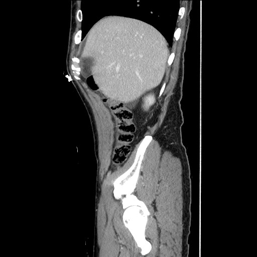 Closed loop small bowel obstruction - omental adhesion causing "internal hernia" (Radiopaedia 85129-100682 C 44).jpg