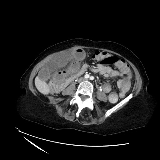 File:Closed loop small bowel obstruction due to adhesive band, with intramural hemorrhage and ischemia (Radiopaedia 83831-99017 Axial 4).jpg