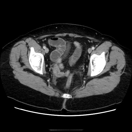 Closed loop small bowel obstruction due to adhesive bands - early and late images (Radiopaedia 83830-99015 A 151).jpg