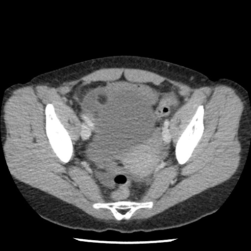 Closed loop small bowel obstruction due to trans-omental herniation (Radiopaedia 35593-37109 A 73).jpg