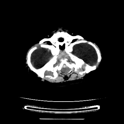 Cloverleaf skull (Radiopaedia 91901-109710 Axial non-contrast 46).jpg
