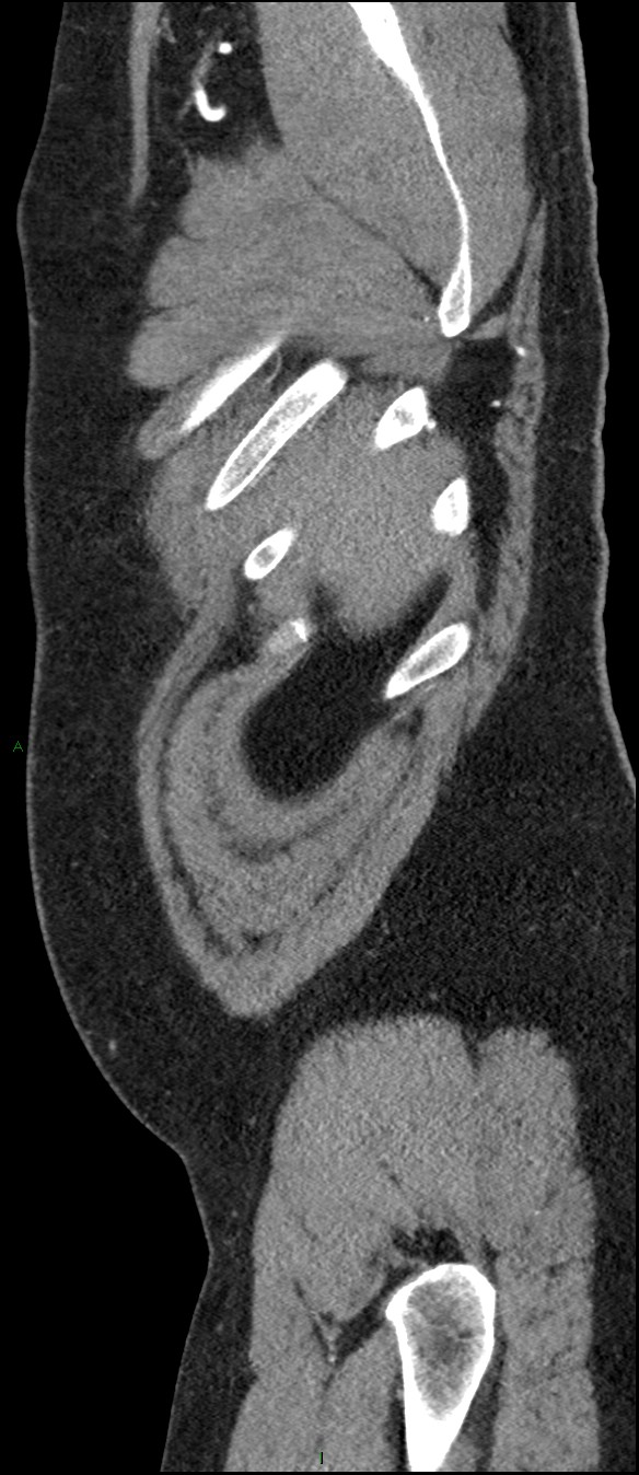 Coarctation of the aorta (Radiopaedia 74632-88521 C 16).jpg