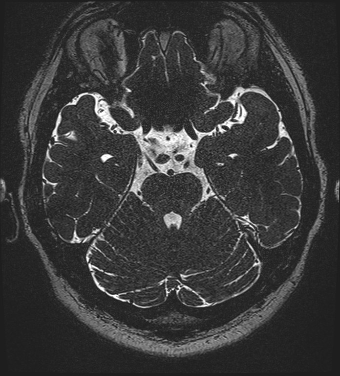 Cochlear incomplete partition type III associated with hypothalamic hamartoma (Radiopaedia 88756-105498 Axial T2 122).jpg