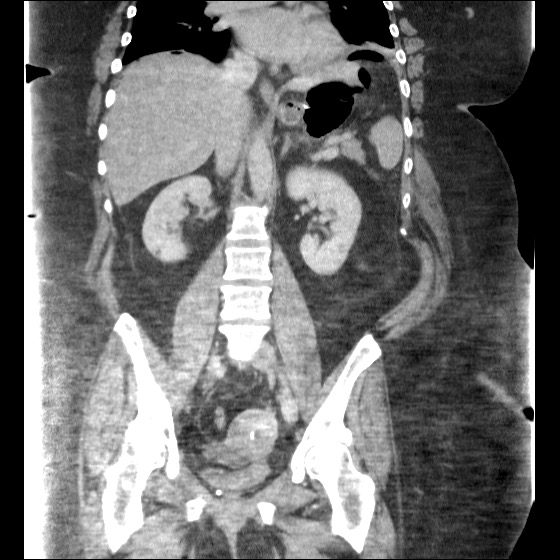 File:Collection due to leak after sleeve gastrectomy (Radiopaedia 55504-61972 B 29).jpg
