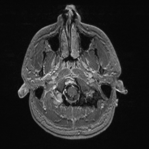 File:Colloid cyst (Radiopaedia 44510-48181 Axial T1 C+ 28).png