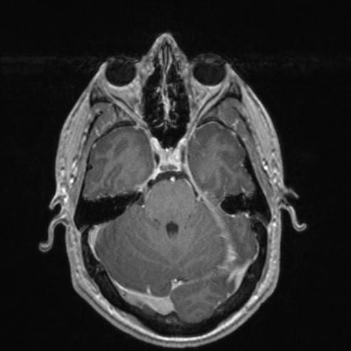File:Colloid cyst (Radiopaedia 44510-48181 Axial T1 C+ 63).png