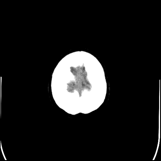 Colloid cyst (Radiopaedia 78104-90633 Axial non-contrast 92).jpg