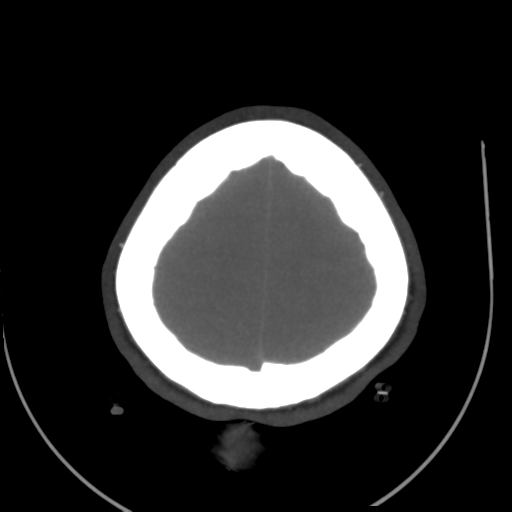 File:Colloid cyst (resulting in death) (Radiopaedia 33423-34499 A 50).png