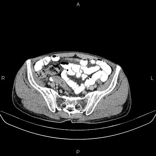 File:Colon adenocarcinoma - hepatic flexure (Radiopaedia 85635-101395 Axial C+ delayed 75).jpg