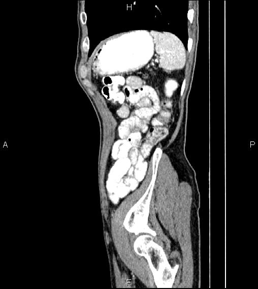 Colon adenocarcinoma - hepatic flexure (Radiopaedia 85635-101395 D 76).jpg