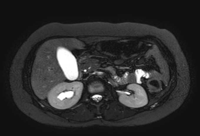 Colon adenocarcinoma with Krukenberg tumors, advanced pregnancy (Radiopaedia 67279-76645 Axial T2 SPAIR 55).jpg