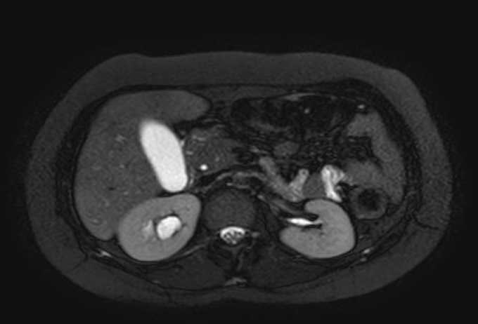 Colon adenocarcinoma with Krukenberg tumors, advanced pregnancy (Radiopaedia 67279-76645 Axial T2 SPAIR 56).jpg