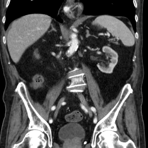File:Colon cancer with duodenal invasion (Radiopaedia 16278-15958 B 36).jpg