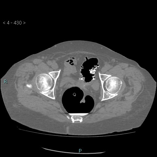 File:Colonic lipomas (Radiopaedia 49137-54244 Axial bone window 192).jpg