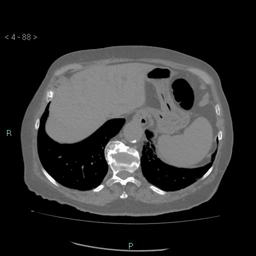 Colonic lipomas (Radiopaedia 49137-54244 Axial bone window 40).jpg