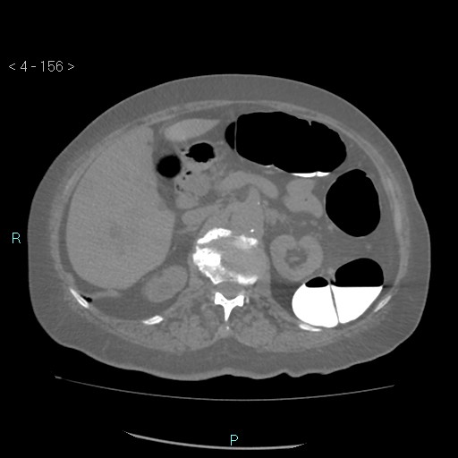 Colonic lipomas (Radiopaedia 49137-54244 Axial bone window 70).jpg