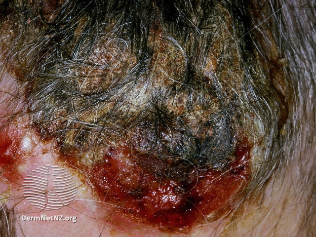 File:Infected eczema (DermNet NZ cutaneous-hodgkin-002).jpg