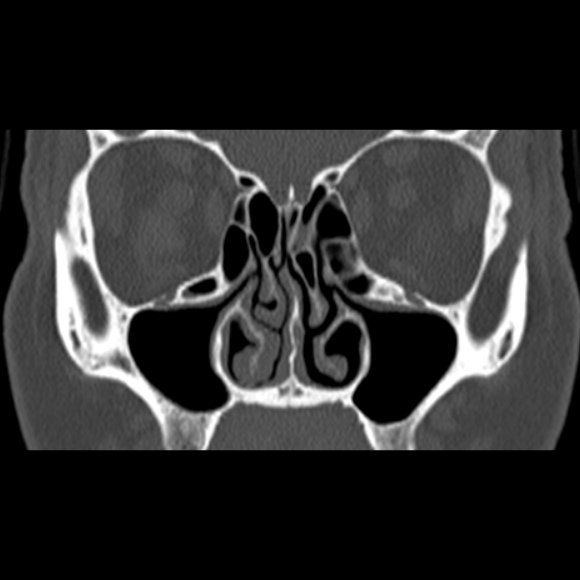 Nasal septal perforation (Radiopaedia 25030-25289 Coronal bone window 32).jpg