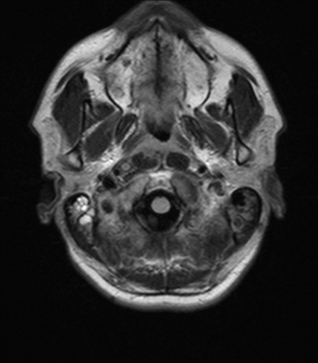 File:Nasopharyngeal carcinoma with pterygopalatine fossa involvement (Radiopaedia 33102-34134 Axial FLAIR 2).png