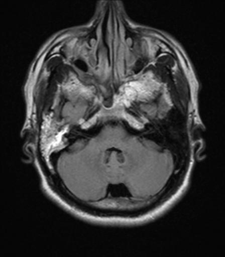 File:Nasopharyngeal carcinoma with pterygopalatine fossa involvement (Radiopaedia 33102-34134 Axial FLAIR 6).png