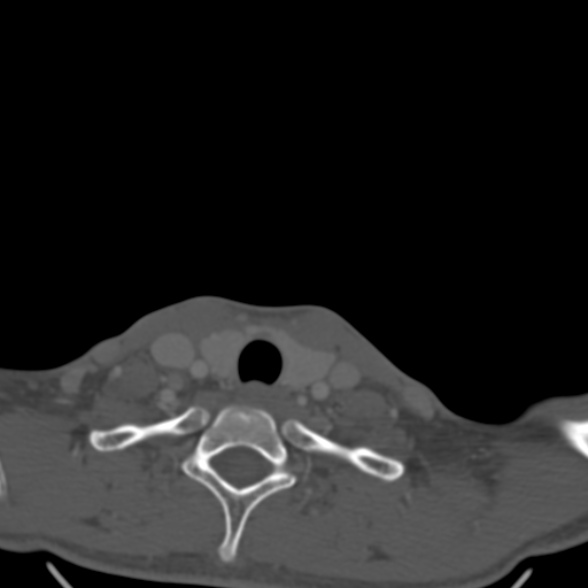 Nasopharyngeal carcinoma with skull base invasion (Radiopaedia 53415-59705 Axial bone window 184).jpg