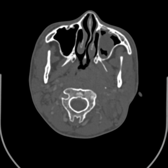 Nasopharyngeal carcinoma with skull base invasion (Radiopaedia 53415-59705 Axial bone window 62).jpg
