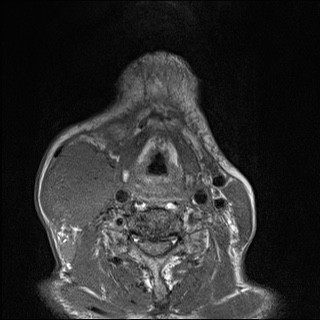 Nasopharyngeal carcinoma with skull base invasion (Radiopaedia 59258-66600 B 51).jpg