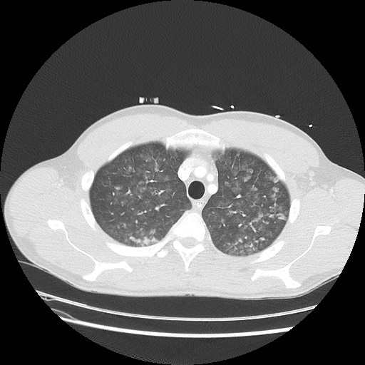 Near-drowning pulmonary edema (Radiopaedia 59457-66814 Axial lung window 13).jpg