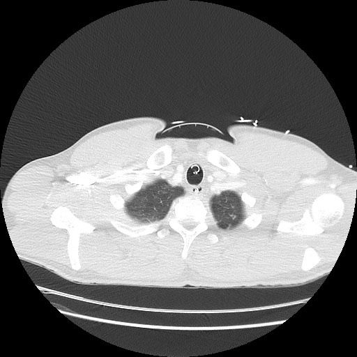 Near-drowning pulmonary edema (Radiopaedia 59457-66814 Axial lung window 4).jpg