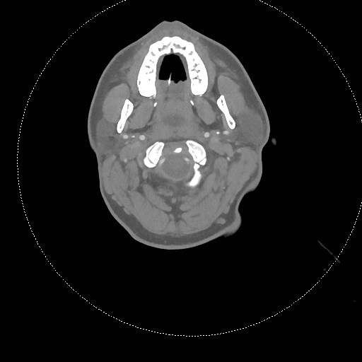 Neck CT angiogram (intraosseous vascular access) (Radiopaedia 55481-61945 B 239).jpg