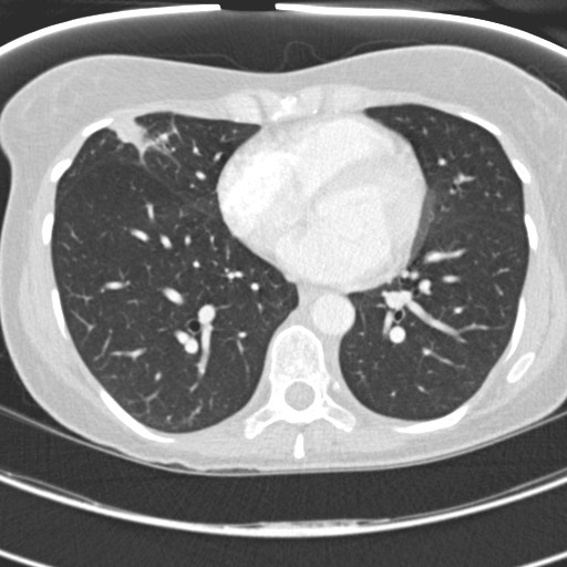 Necrobiotic pulmonary nodules - Crohn disease (Radiopaedia 20723-20631 Axial lung window 91).jpg