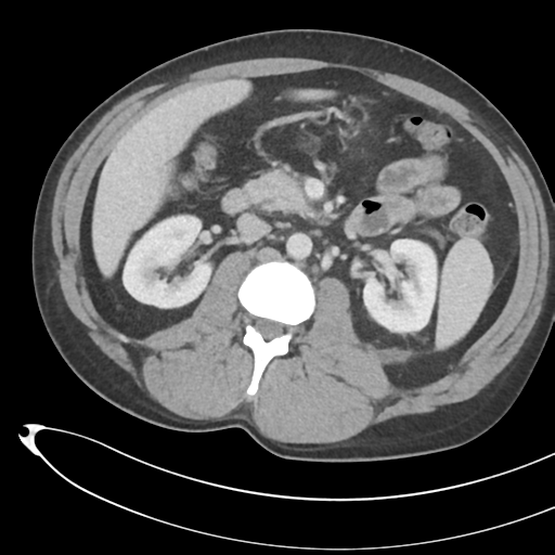 File:Necrotizing pancreatitis with acute necrotic collections (Radiopaedia 38829-41012 B 36).png
