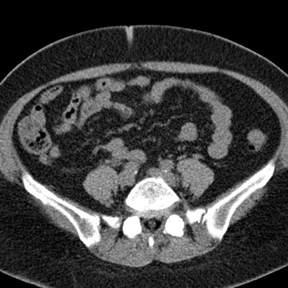File:Nephrostomy for urosepsis (Radiopaedia 26180-26330 Axial non-contrast 42).jpg