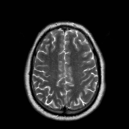 File:Neuro-Behcet's disease (Radiopaedia 21557-21505 Axial T2 17).jpg