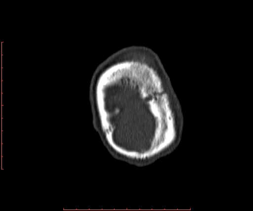 File:Neuroblastoma skull metastasis (Radiopaedia 56053-62683 Coronal bone window 42).jpg