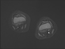 File:Neuroblastoma with bone metastases (Radiopaedia 67080-76414 Axial STIR 10).jpg