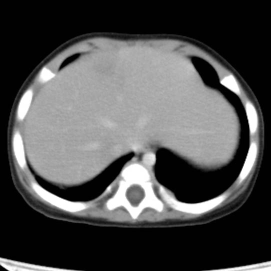 File:Neuroblastoma with skull metastases (Radiopaedia 30326-30960 C 5).jpg