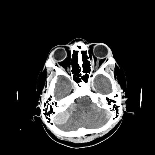 File:Neurofibromatosis type 2 (Radiopaedia 25389-25637 Axial C+ 14).jpg