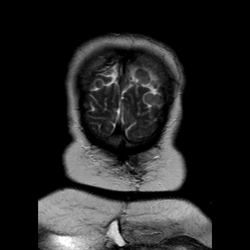 File:Neurofibromatosis type 2 (Radiopaedia 8713-9518 Coronal T2 25).jpg