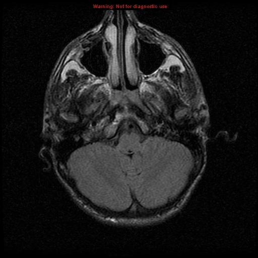 File:Neurofibromatosis type 2 (Radiopaedia 8953-9730 Axial FLAIR 7).jpg