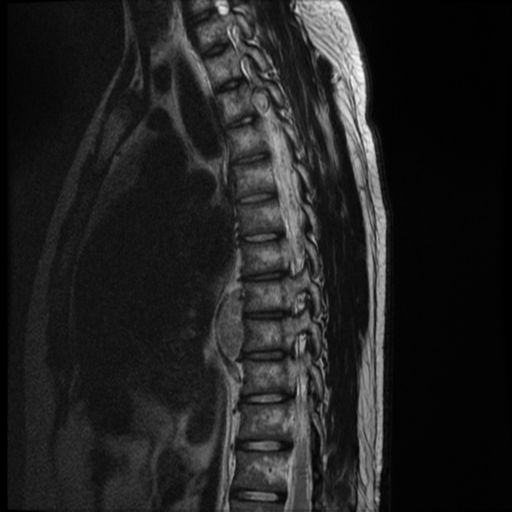 File:Neurofibromatosis type 2 (spinal manifestations) (Radiopaedia 53943-60070 C 9).png