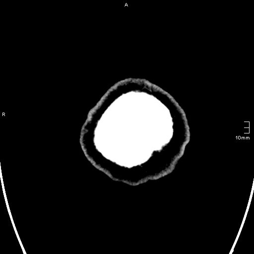 File:Neurotoxoplasmosis - concentric target sign (Radiopaedia 70644-80783 Axial non-contrast 44).jpg