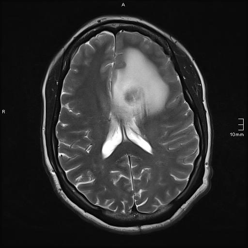 File:Neurotoxoplasmosis - concentric target sign (Radiopaedia 70644-80784 Axial T2 13).jpg