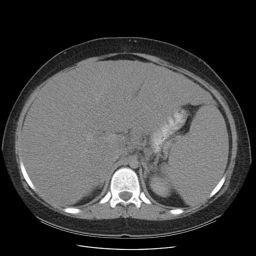 File:Non-Hodgkin lymphoma involving pelvis (Radiopaedia 21281-21197 B 21).jpg