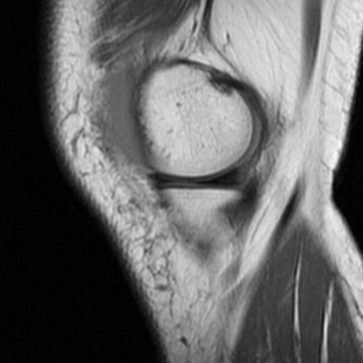 File:Non-displaced patella fracture (Radiopaedia 15932-15582 Sagittal T1 3).jpg