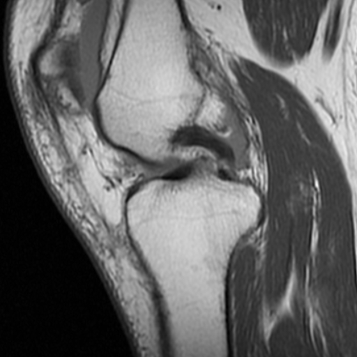 File:Non-displaced patella fracture (Radiopaedia 15932-15582 Sagittal T1 8).jpg